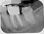 Fig 2. Pretreatment radiograph of mandibular left first molar. The mesial root exhibited a well-defined radiolucency consistent with apical periodontitis.