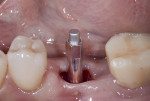 Fig 5. ISQ values of 35 (buccal-lingual) and 37 (mesial-distal) were measured at 6 weeks.