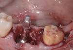 Fig 3. A SmartPeg was attached to the implant at the time of implant placement, and ISQ values of 71 (buccal-lingual) and 77 (mesial-distal) were recorded.