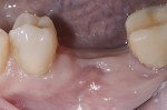 Fig 7. After a cover screw had been placed,
soft tissue had healed over the submerged implant.