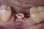 Fig 9. A PEEK healing abutment was seated following transgingival exposure of the implant.