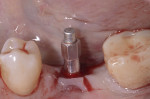 Fig 8. RFA values were taken after 16 weeks
of submergence of the dental implant. ISQ values were 71 (buccal-lingual) and 77 (mesial-distal).