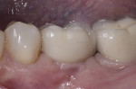 Fig 10. Screw-retained metal-ceramic crown 6 months post-treatment (prosthetics by Howard
Rosenthal, DDS, Newtown, Pennsylvania).
