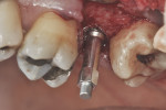 Fig 12. Immediately after implant placement a SmartPeg was attached to the implant to
confirm primary stability; ISQ values of 71 (buccal-palatal) and 70 (mesial-distal) were recorded.