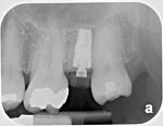 Fig 13. Periapical radiograph taken at the conclusion of the implant surgery showed the implant and PEEK healing abutment and bone levels relative to the dental implant platform.