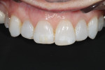 Fig 3. Retracted view showing uneven incisal edges against black contrast and gingival levels.