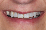 Fig 2. Smile view showing low lip line and lingually positioned tooth No. 5.