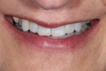 Fig 4. Tipped-down smile view showing maxillary incisal edges short of the inner vermillion border of the lower lip.