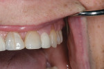 Figure  13  PREPARATION AND RESTORATION  The patient was recalled 3 days after the restorations were placed. Note the gingival healing and blending of the restoration into the gingiva.