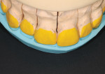 Fig 7. APM putty matrix applied to unprepared
teeth model for space visualization.