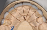 Fig 8. Occlusal view of master cast showing symmetrical balance from Nos. 5 through 12 on indirect porcelain restorations.