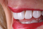 Fig 14. Lateral smile view showing natural esthetic blend in harmony with the lips.