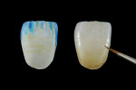 Fig 1. Monolithic zirconia crown painted with dip stains in the green state (left) and then externally painted after it is sintered (right).