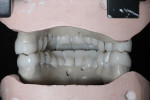 Fig 6. Lithium-disilicate crowns crystallized and finished. (Frames and crowns produced by Dr. Kent J. Howell.)