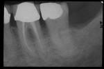 Figure  3  CLINICAL EXAMPLES Tooth No. 19, filled canals