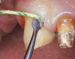 Figure  4  Placement of GingiBRAID+ for crown impression.