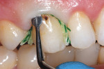 Figure  5  Placement of GingiBRAID+ for Class V composite restoration.