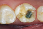 Figure  1  Clinical Case The prepared tooth No. 3 after removal of the temporary restoration.
