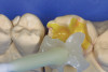 Figure 10  Note that 4 to 6 weeks following the gingivectomy and re-preparation, the tissue is rebounding coronally over the margins of the temporary restorations.