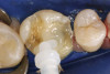 Figure 11  This is a 4-year recall photograph following placement of the final restorations.