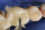 Figure  4  Clinical Case The restoration was seated with an amalgam condenser.
