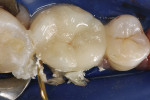 Figure  5  Clinical Case After light-curing via the wave technique, excess cement was removed with a sickle scaler.