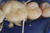 Figure 14  Very dark roots and 3 mm of sulcus depth make the possibility of recession a concern. On the incisors, the decision was made to perform a gingivectomy and create a 1-mm sulcus, followed by placing the margins 0.5 mm below tissue. On the canine a gingivectomy would result in an excessively long tooth compared to the opposite canine, so the decision was made to prepare one-half the depth of the 3-mm sulcus below tissue and hope for no recession. If any occurs, the margin should remain below tissue.
