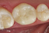 Figure 16  The first step in controlling margin placement is to prepare the tooth even with the gingival margin.
