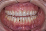 Preoperative, retracted smile photograph showing lower anterior black triangles and postoperative result of upper black triangle closure.