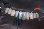 ooth etched and bonded with a small amount of flowable composite placed.
