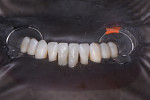 Facial view of teeth Nos. 24 and 25 after bonding, showing composite flash.