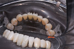 Incisal view of teeth Nos. 24 and 25 after bonding, showing composite flash.