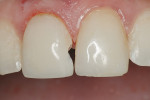 Figure  1   Class III restoration preoperative view (note the long bevel).