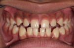 Anterior open bite and bilateral posterior crossbite resulting from soft-tissue dysfunction and improper tongue positioning.