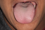 Dimpling in the center of the tongue indicating submucosal tongue-tie, which was the etiology of the conditions presented in Figure 2.