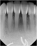Postoperative periapical x-ray image.
