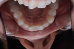 Unretracted and retracted smile photographs showing rotated central incisors with worn
incisal edges.
