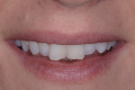 Unretracted and retracted smile photographs showing rotated central incisors with worn
incisal edges.