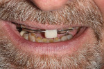 Modifying the deprogrammer to show ideal tooth position was helpful in planning for success.