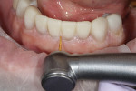 Gingival finishing was critical for at-home
care.