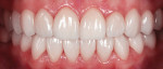 Patient smile makeover using complete
FirstFit Guided Veneers Delivery System.