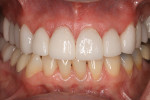 Final veneers seated with Prime&Bond elect® and Calibra® Veneer Esthetic Resin Cement in translucent shade.