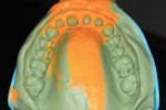 Aquasil Ultra+ used to capture impression of upper arch. Light body material incorporated
to capture fine marginal detail.