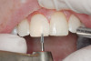 Figure 10  This patient presented with a deepdental overbite, tooth size discrepancy, and improper angulations of anterior and posterior teeth. Note the  upright canines and retroclined lower incisors. The cover (maxillary arch) does not fit the box (mandibular arch).