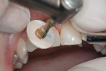 Figure  12  A disc system (FlexiDisc System by Cosmedent) from coarse to superfine was used to achieve a high polish and invisibly blend composite into the tooth structure. Note the high flex and resilience of the discs.