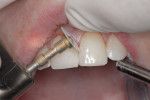 Figure  13  A disc system (FlexiDisc System by Cosmedent) from coarse to superfine was used to achieve a high polish and invisibly blend composite into the tooth structure. Note the high flex and resilience of the discs.