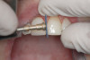 Figure 3  Orthodontics has intruded the incisors to create space to bond them to a pleasing length.