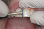 Figure  14  A disc system (FlexiDisc System by Cosmedent) from coarse to superfine was used to achieve a high polish and invisibly blend composite into the tooth structure. Note the high flex and resilience of the discs.
