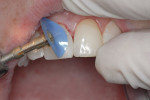Figure  15  A disc system (FlexiDisc System by Cosmedent) from coarse to superfine was used to achieve a high polish and invisibly blend composite into the tooth structure. Note the high flex and resilience of the discs.