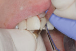 Figure  16  Gingival torquing opened the contact to start the interproximal finishing.